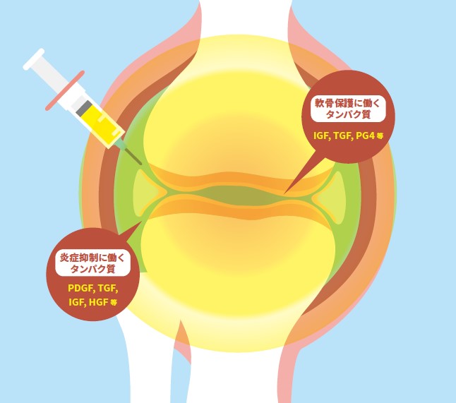 ACP PRP療法とは？