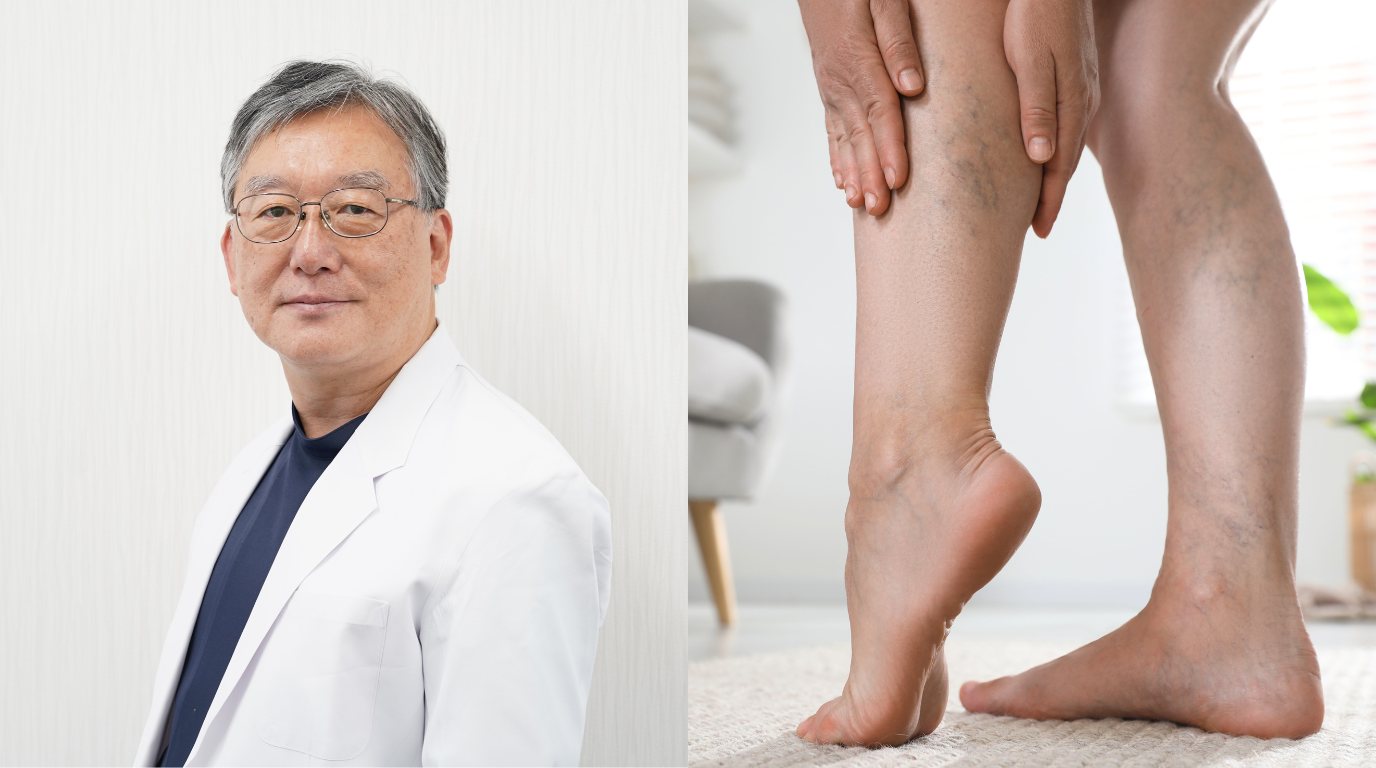 「足がつる・むくむ・だるい」は“下肢静脈瘤”の初期症状かも? 見逃してはいけないサインを医師に聞く